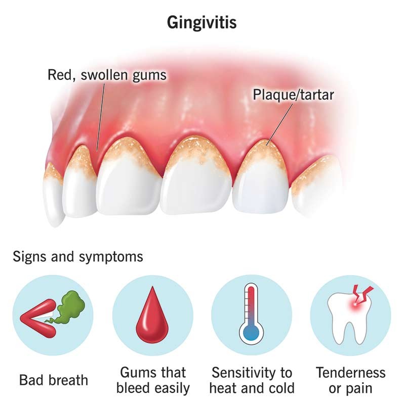 10950-gingivitis